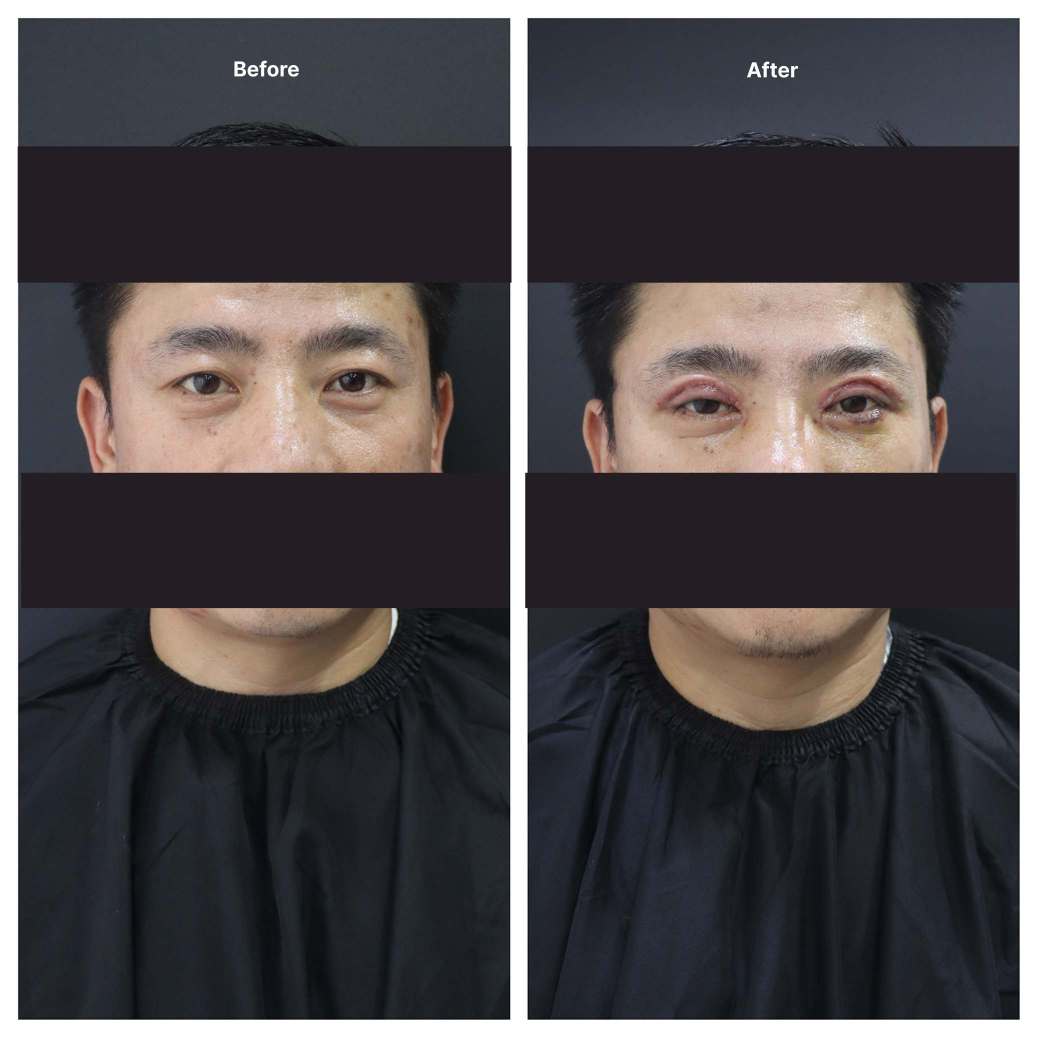 Eyelid Surgery KOQ10